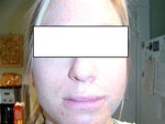 After restylane: this is as bad as the swelling got. It only felt like a duck bill for a few hours!